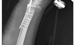 Sahipsiz köpeklerin saldırısından kaçmak isterken bileği kırıldı